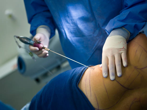 Best Liposuction Surgeon in Mulund Liposuction Surgeon